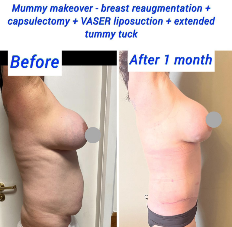 Mummy makeover at the Harley Clinic (VASER lipo, tummy tuck, breast re-augmentation, capsulectomy)