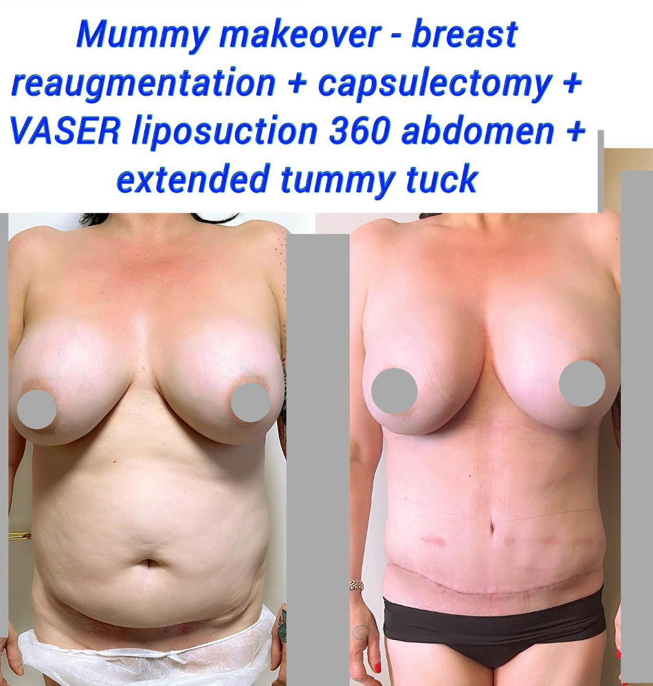 Cambio de imagen de momia en la Clínica Harley (lipo VASER, abdominoplastia, aumento de senos, capsulectomía)