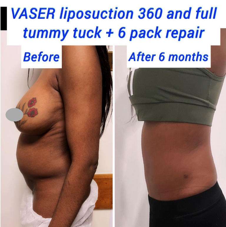 Before and after VASER liposuction 360 and full tummy tuck with muscle repair