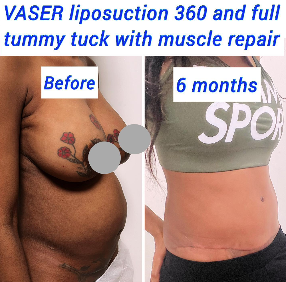 Antes y después liposucción VASER 360 y abdominoplastia completa con reparación muscular