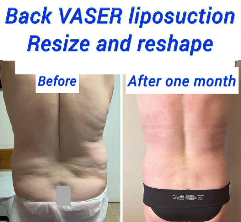 Back VASER liposuction resize and reshape before and after one month