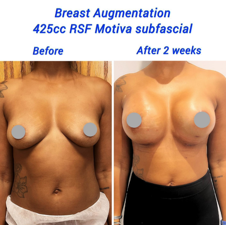 Before and after breast augmentation 425cc RSF Motiva subfascial, the Harley Clinic London