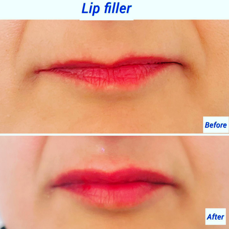 Before and after lip filler, the Harley Clinic