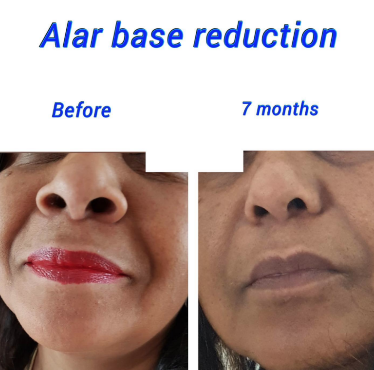Before and after alar base reduction, nostril reduction at the Harley Clinic