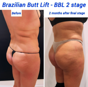 Before and after Brazilian butt lift stage 2 at The Harley Clinic