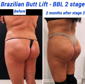 Before and after Brazilian butt lift stage 2 at The Harley Clinic