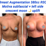 Breast augmentation 380cc RSC Motiva subfascial + left side crescent moon uplift