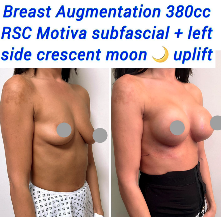 Breast augmentation 380cc RSC Motiva subfascial + left side crescent moon uplift