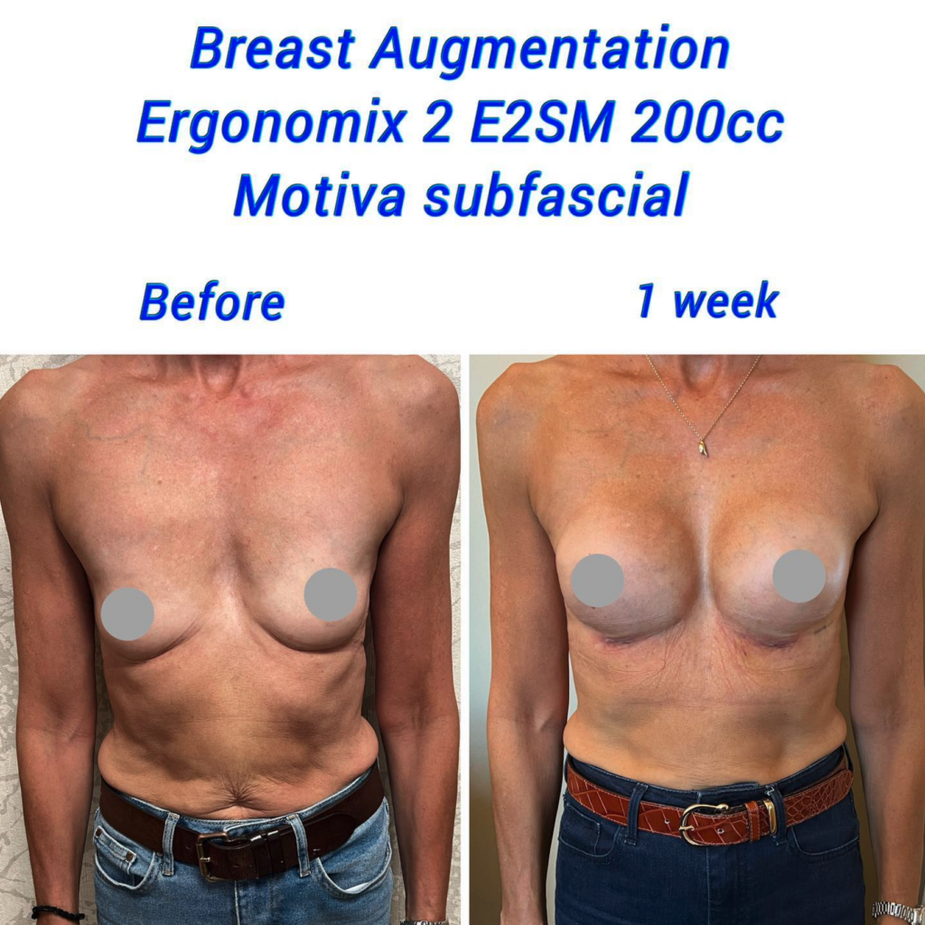 Antes y después Aumento de senos Ergonomix 2 E2SM 200cc Motiva subfascial
