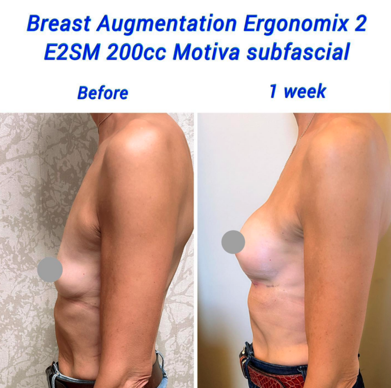 Before and after Breast augmentation Ergonomix 2 E2SM 200cc Motiva subfascial