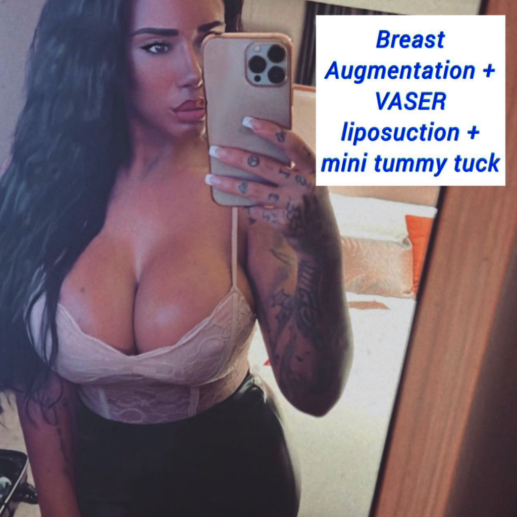 Breast augmentation, VASER liposuction, mini tummy tuck - The Harley Clinic London
