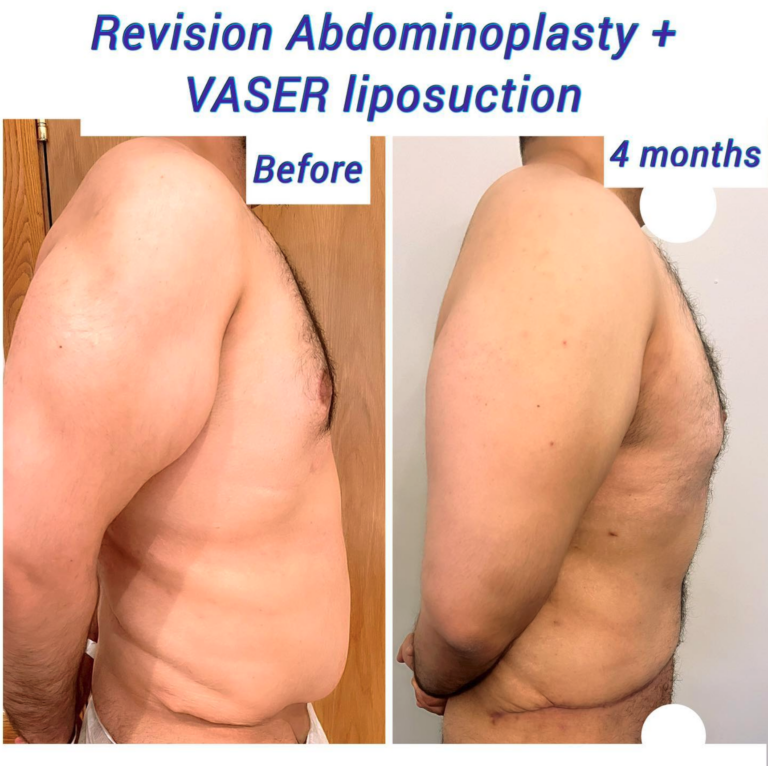 Before and after revision abdominoplasty and VASER liposuction, The Harley Clinic