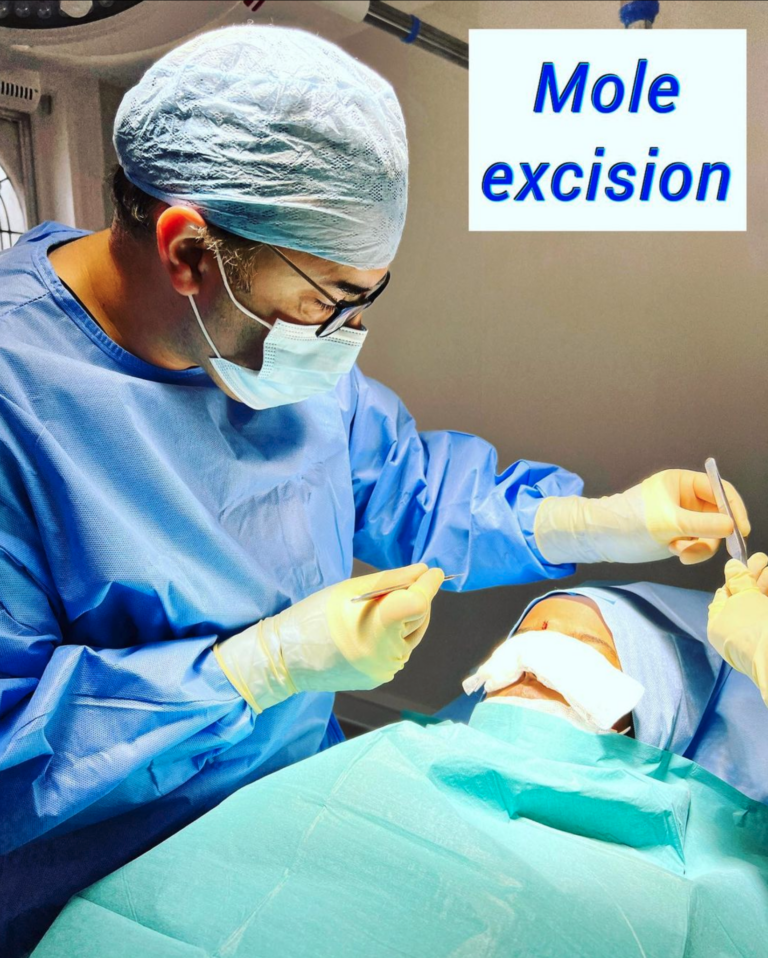Mole excision, The Harley Clinic London
