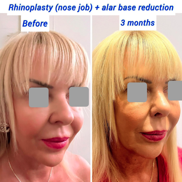 Before and after rhinoplasty and alar base reduction at The Harley Clinic