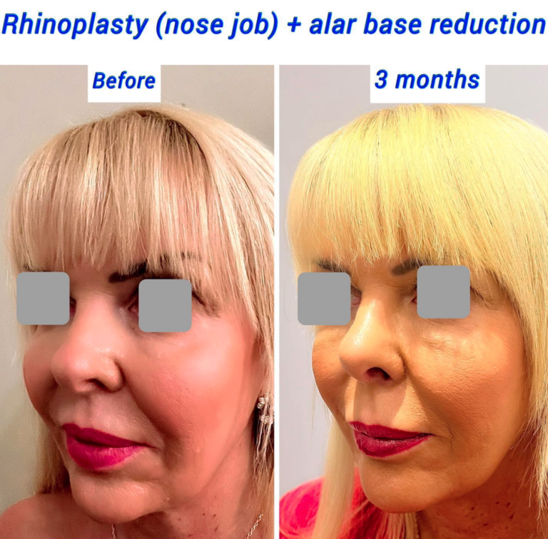 Before and after rhinoplasty and alar base reduction at The Harley Clinic