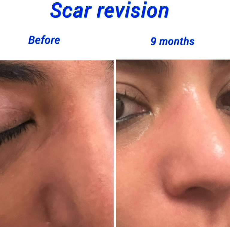 Before and after scar revision at the Harley Clinic London