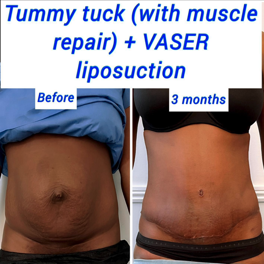 Antes y después de una abdominoplastia con reparación muscular y liposucción VASER, The Harley Clinic London
