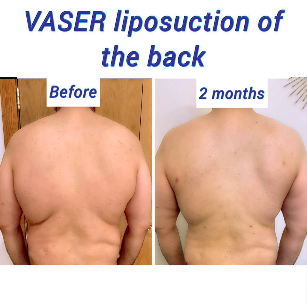 Before and after VASER liposuction of the back - The Harley Clinic London