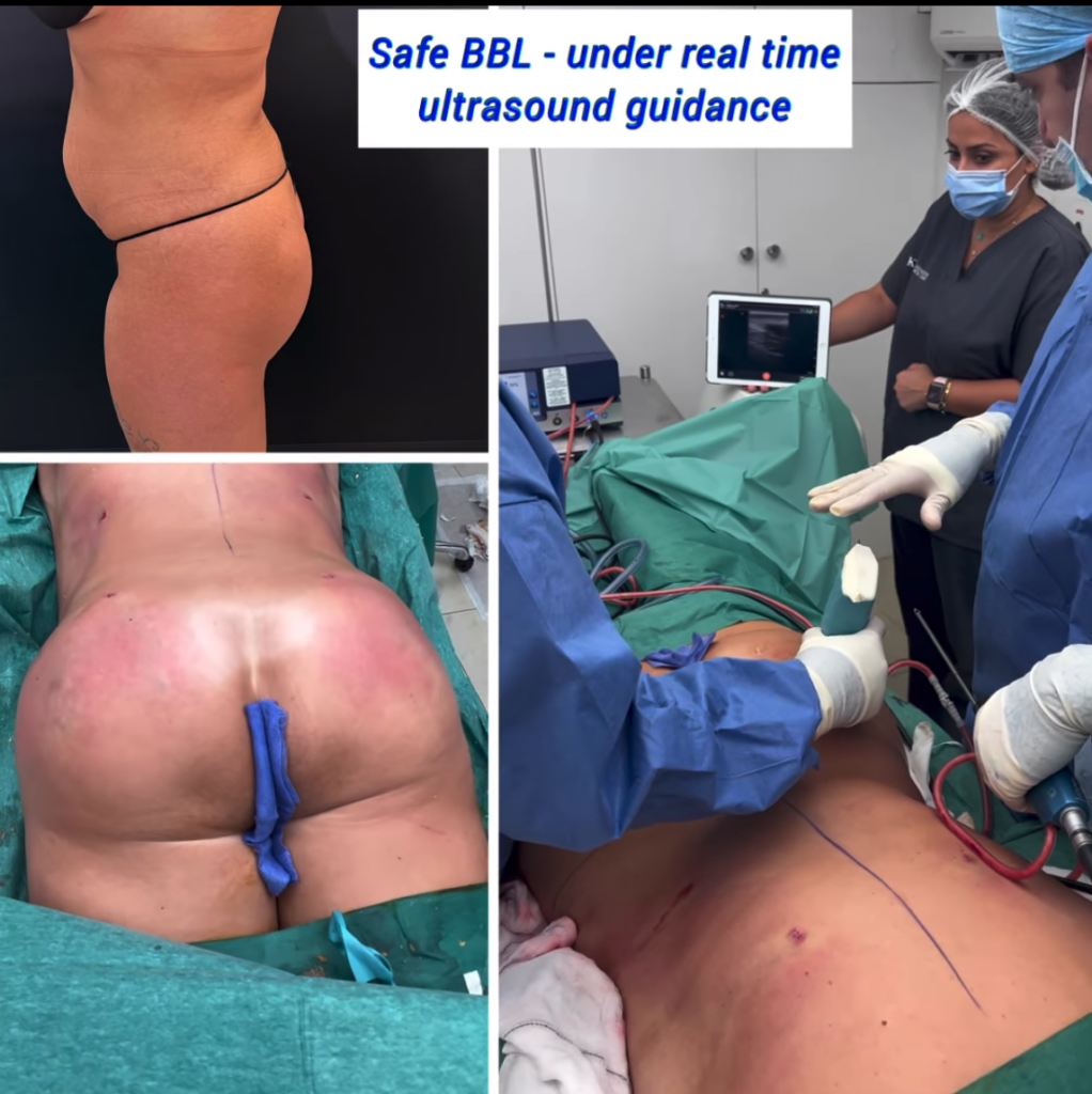 Safe BBL - under real time ultrasound guidance - The Harley Clinic, London