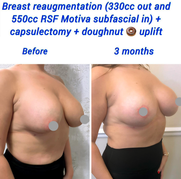 Breast re-augmentation (330cc out and 550 RSF Motiva subfascial in) + capsulectomy + doughnut uplift - The Harley Clinic, London