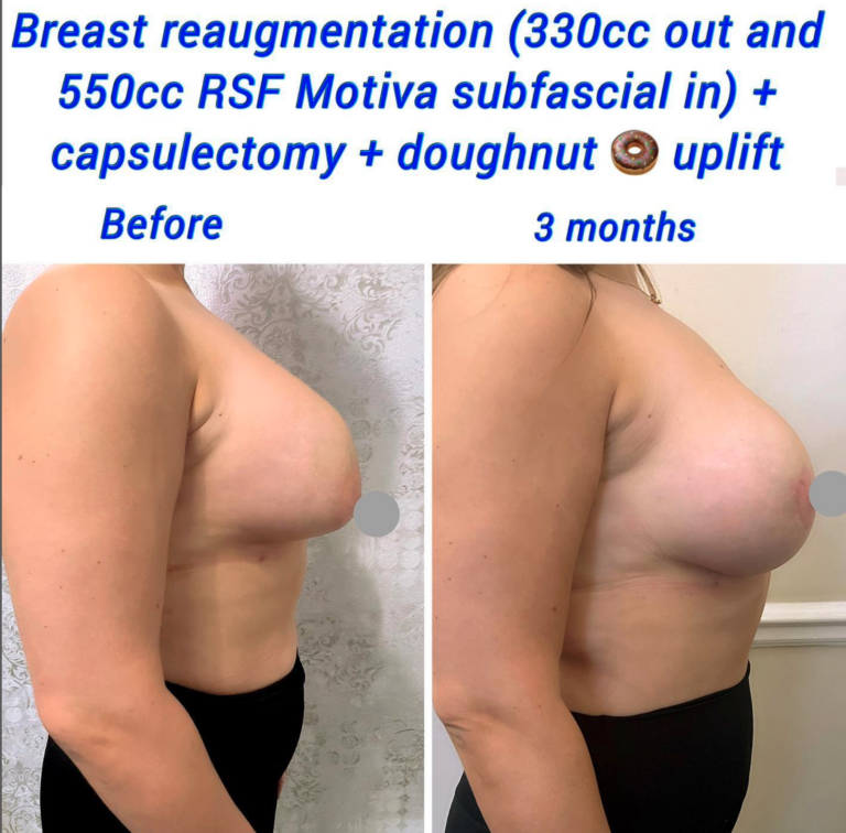 Breast re-augmentation (330cc out and 550 RSF Motiva subfascial in) + capsulectomy + doughnut uplift - The Harley Clinic, London