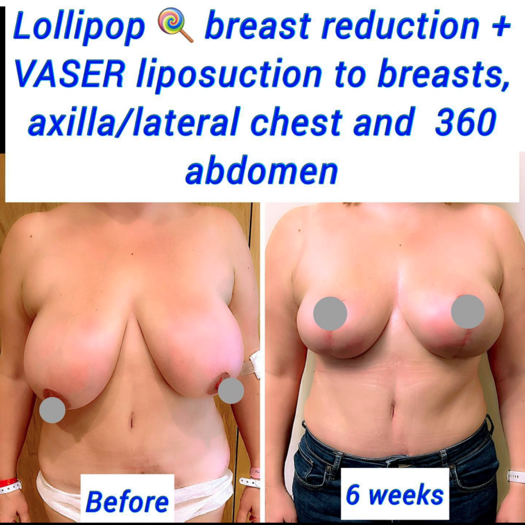 Lollipop breast reduction and VASER liposuction to breasts, axilla/lateral chest and 360 abdomen - The Harley Clinc