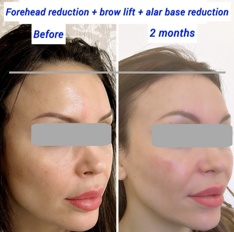 forehead reduction + brow lift + alar base reduction