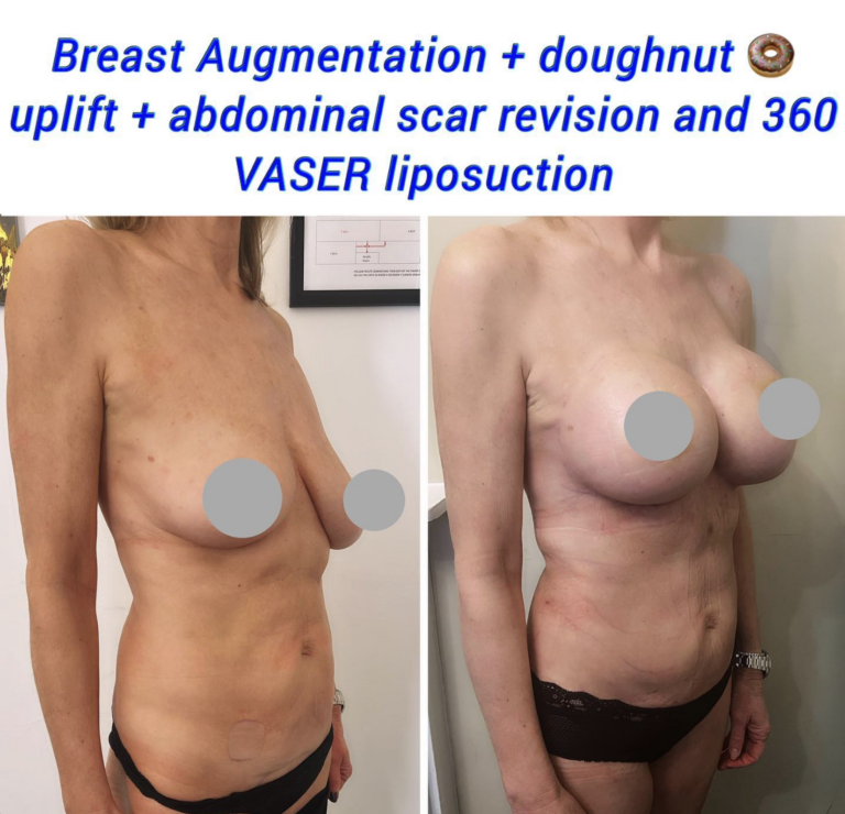 Breast Augmentatio-Mastopexy 1
