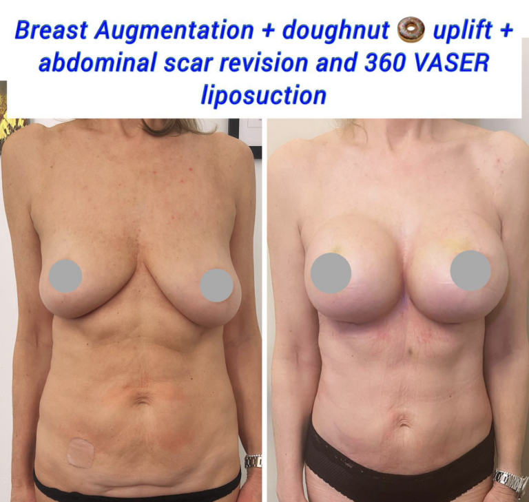 Breast Augmentatio-Mastopexy 2