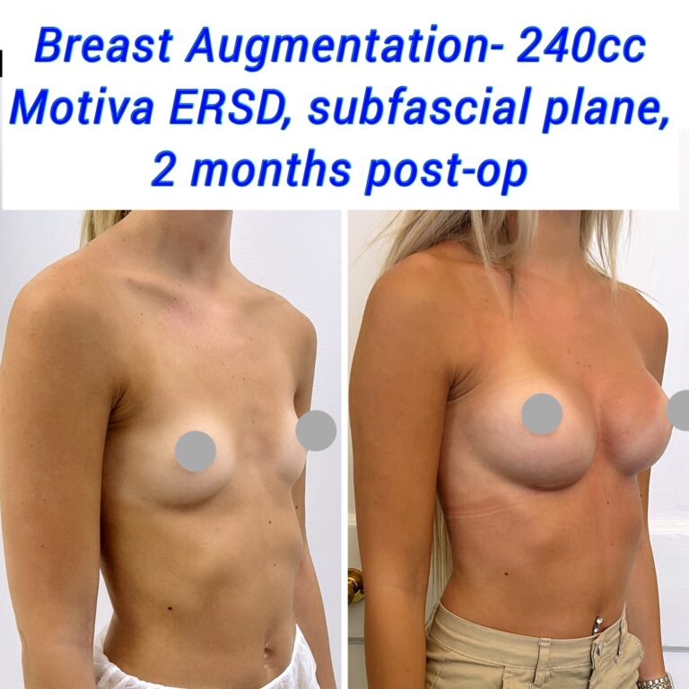Breast Augmentation 3