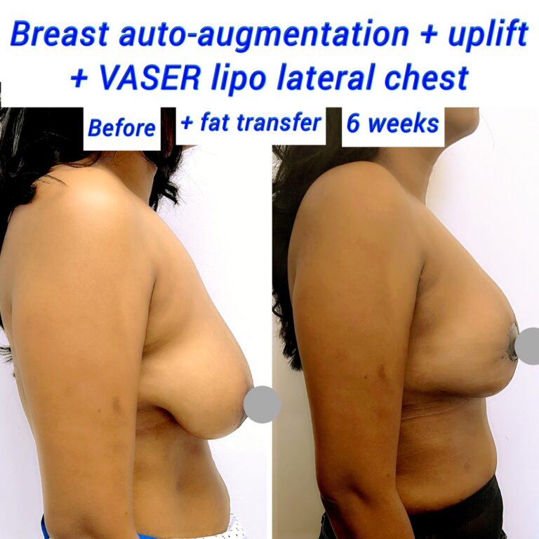 fat transfer to the breasts