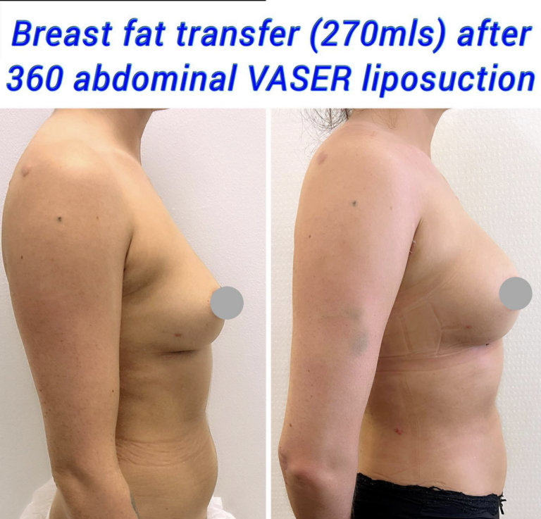 Breast fat transfer 1
