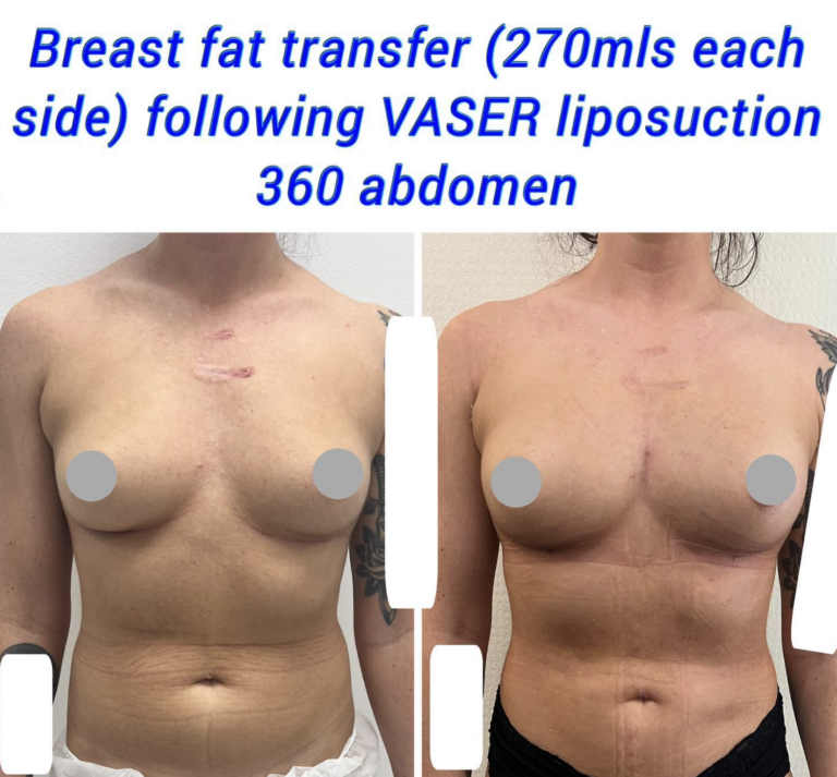 Breast fat transfer 3