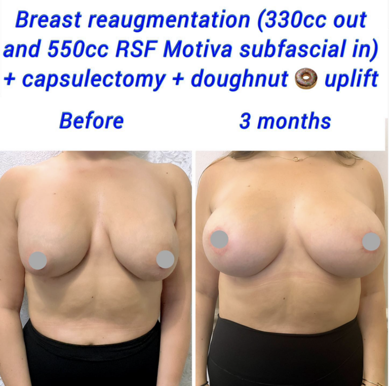 Breast reaugmentation + lift 1