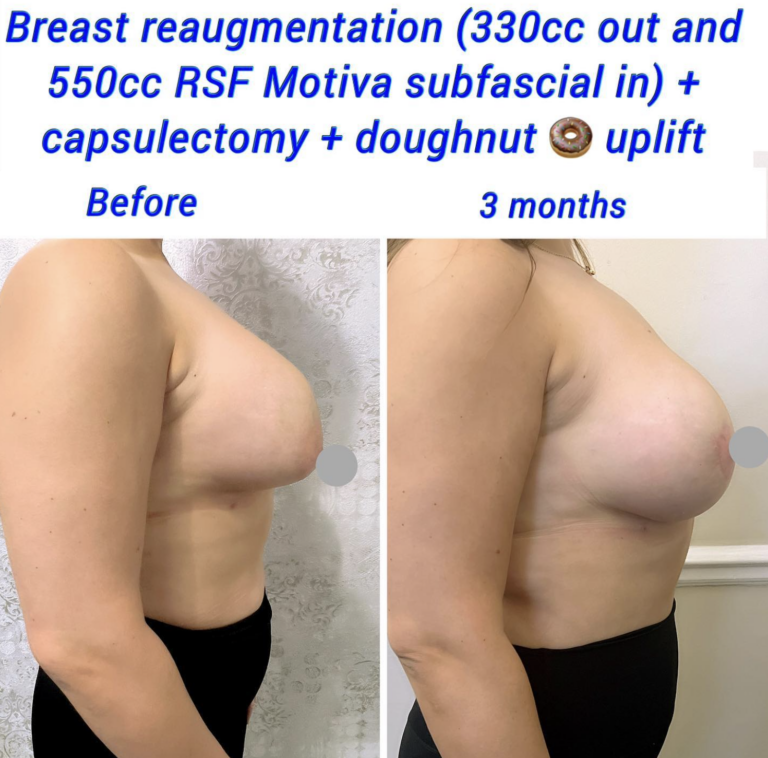 Breast reaugmentation + lift