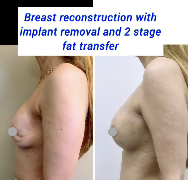Breast reconstruction with fat transfer 1
