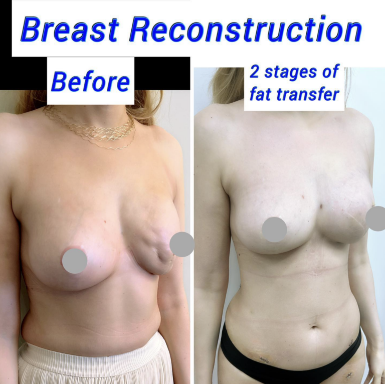 Breast reconstruction with fat transfer 2