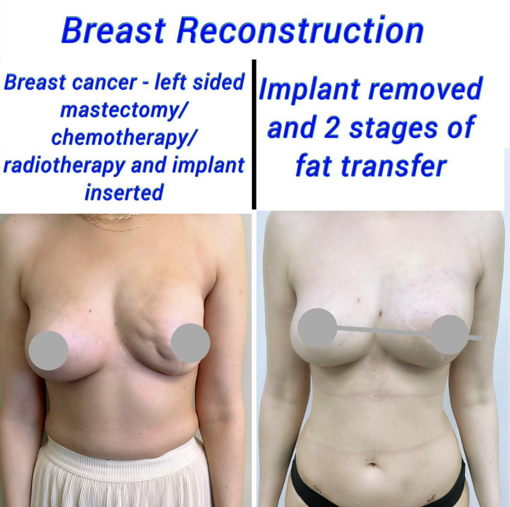 Breast fat transfer