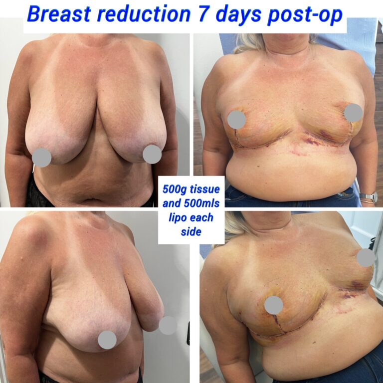 Breast reduction + liposuction