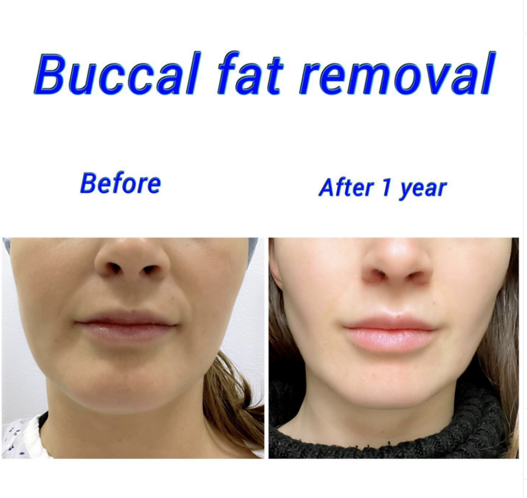 Buccal fat pad removal