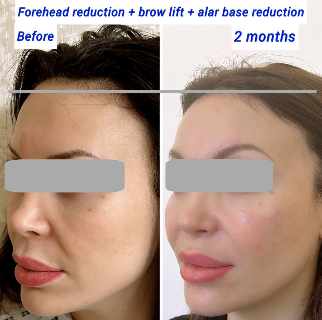 Forehead reduction and brow lift