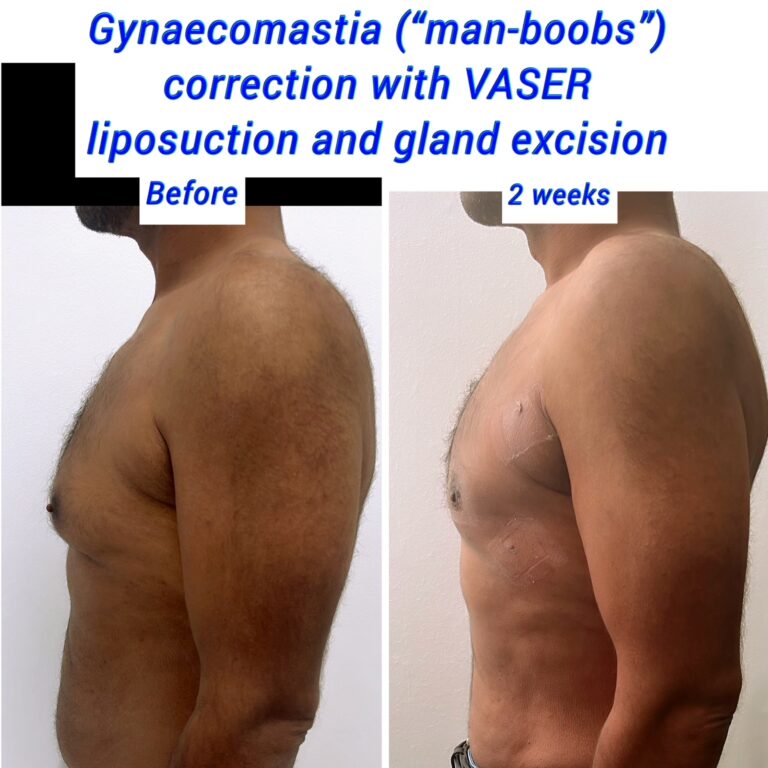 Gynaecomastia or man boobs