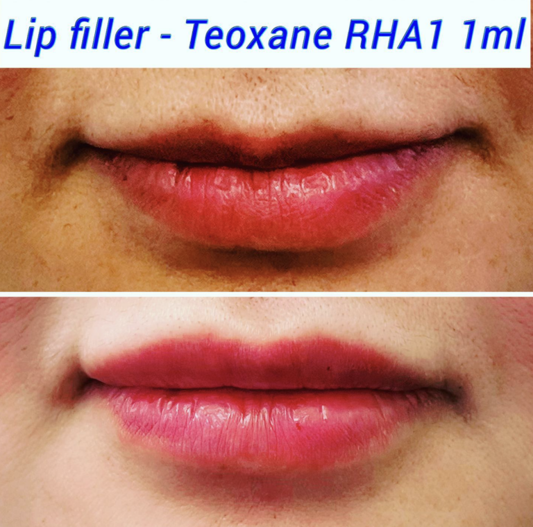 Lip Filler 1