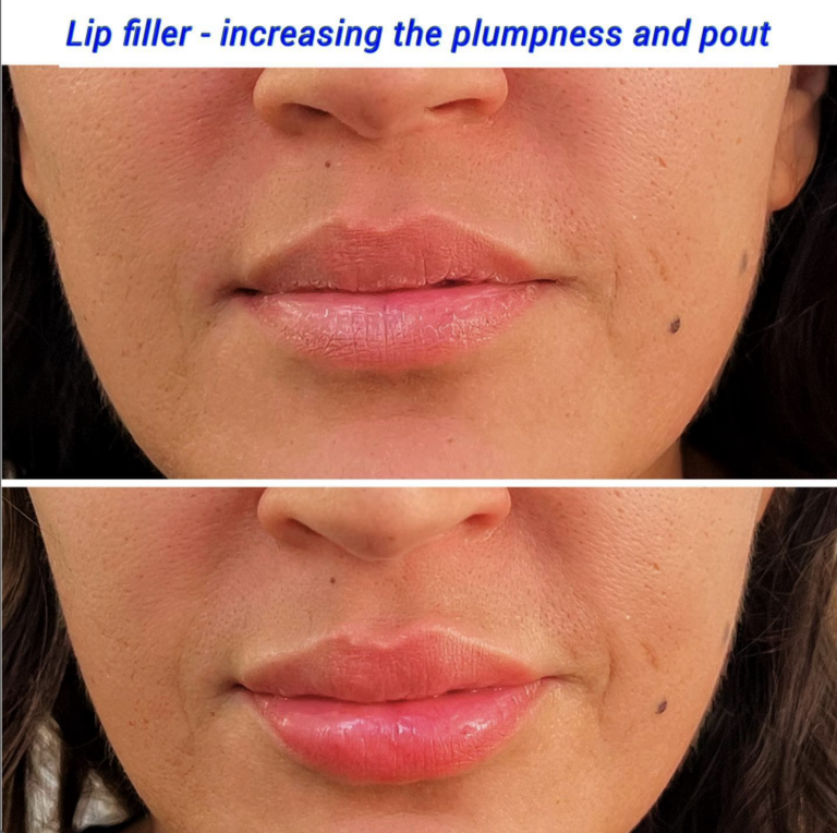 Lip Filler 2