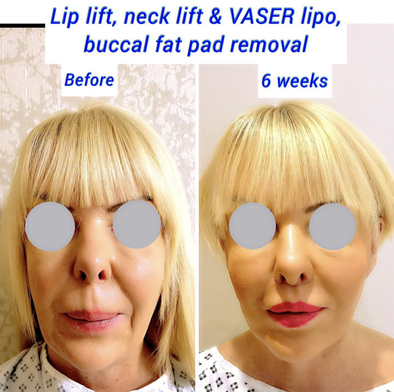 Lip lift, neck lift, VASER liposuction and buccal fat pad