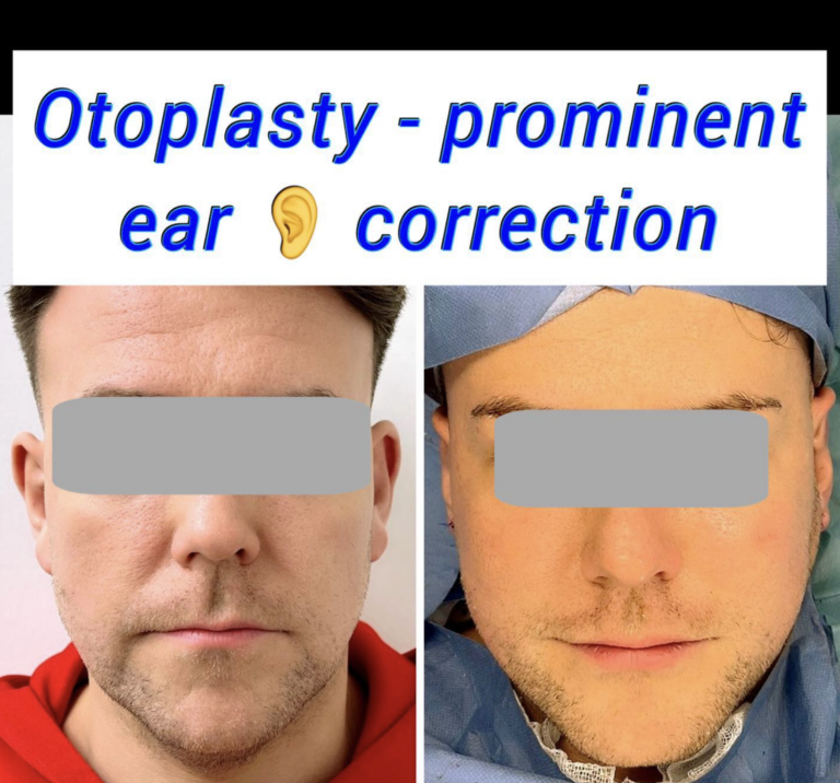 Prominent ear correction