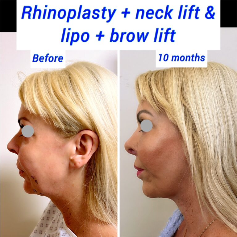 Rhinoplasty + neck lift + brow lift