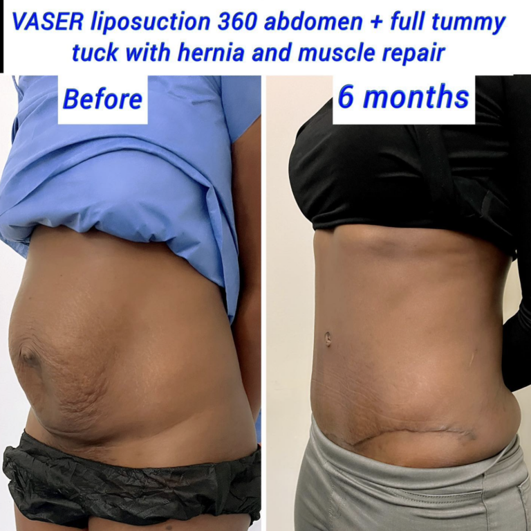 Tummy tuck and VASER liposuction