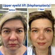 Upper Eyelid Blepharoplasty Plastic Surgery Harley Clinic