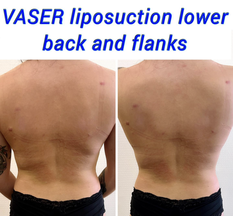 VASER liposuction lower back and flanks